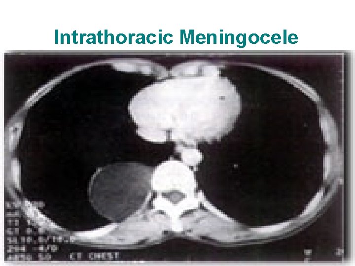 Intrathoracic Meningocele 