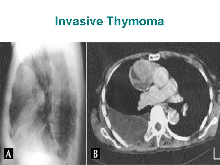 Invasive Thymoma 