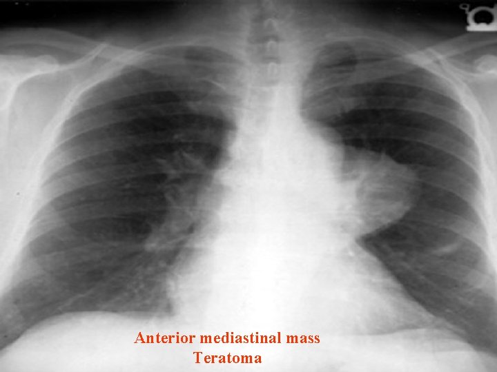 Anterior mediastinal mass Teratoma 