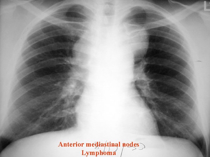 Anterior mediastinal nodes Lymphoma 