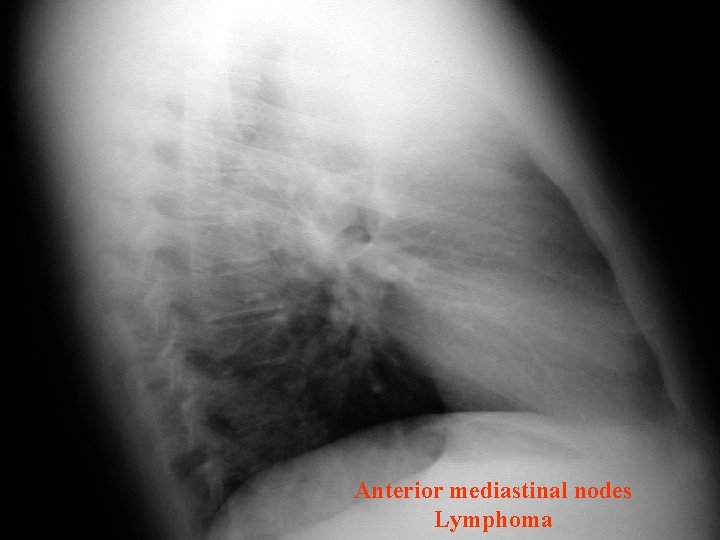 Anterior mediastinal nodes Lymphoma 
