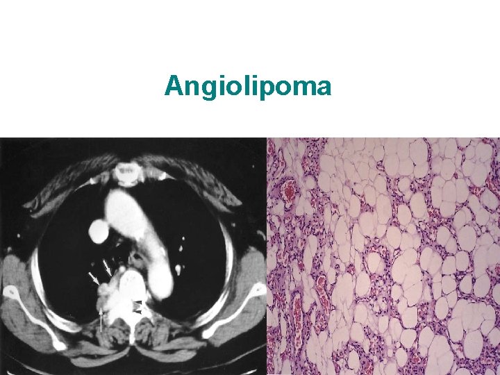 Angiolipoma 