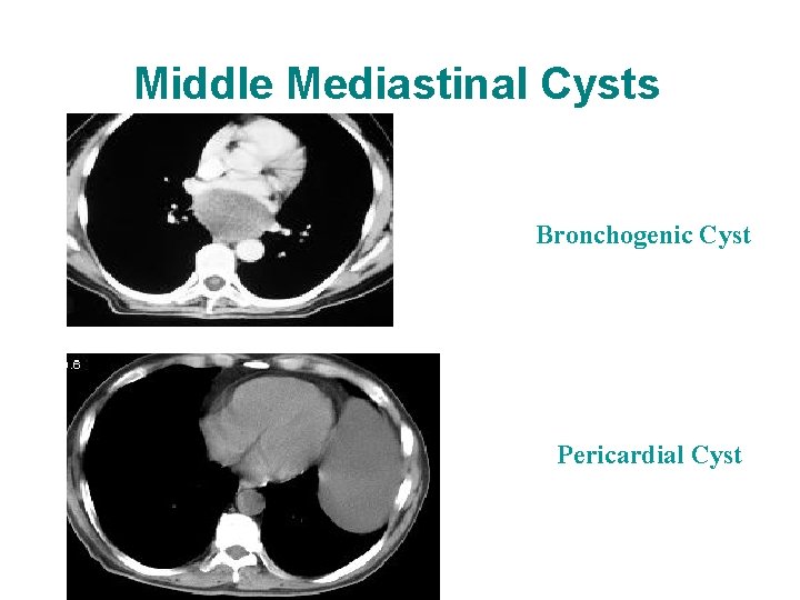 Middle Mediastinal Cysts Bronchogenic Cyst Pericardial Cyst 