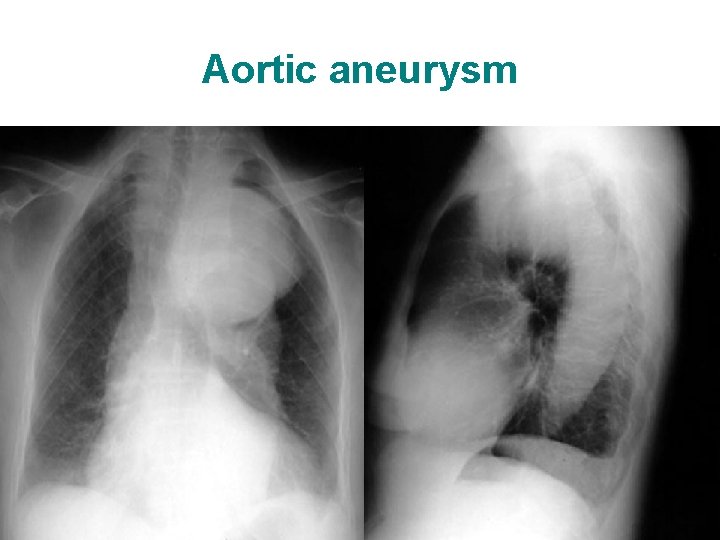 Aortic aneurysm 