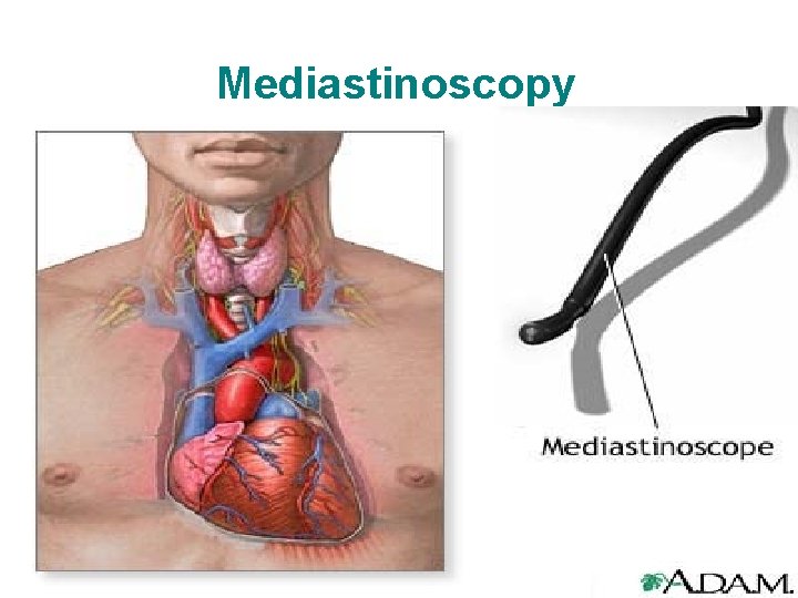 Mediastinoscopy 