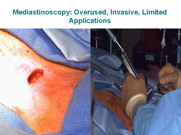 Mediastinoscopy: Overused, Invasive, Limited Applications 