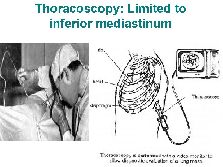 Thoracoscopy: Limited to inferior mediastinum 