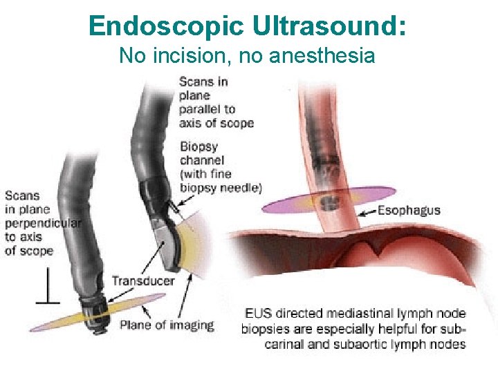 Endoscopic Ultrasound: No incision, no anesthesia 