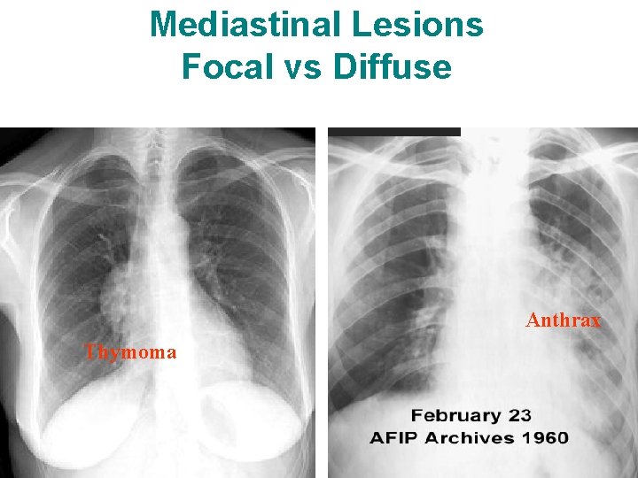 Mediastinal Lesions Focal vs Diffuse Anthrax Thymoma 