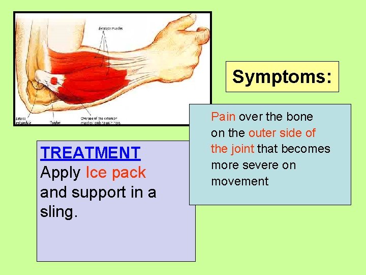 Symptoms: TREATMENT Apply Ice pack and support in a sling. Pain over the bone