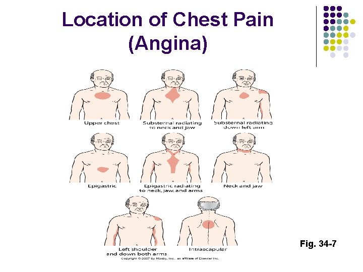 Location of Chest Pain (Angina) Fig. 34 -7 