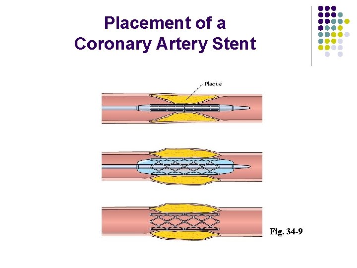 Placement of a Coronary Artery Stent Fig. 34 -9 