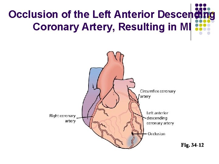 Occlusion of the Left Anterior Descending Coronary Artery, Resulting in MI Fig. 34 -12