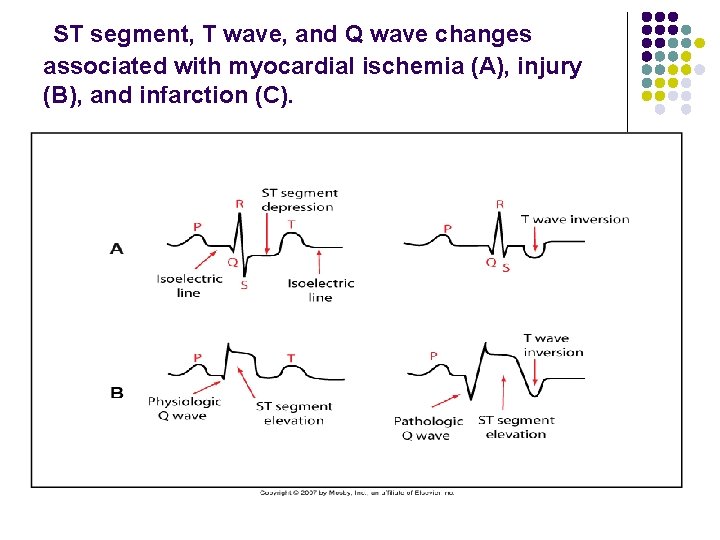 ST segment, T wave, and Q wave changes associated with myocardial ischemia (A), injury
