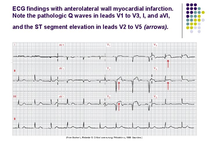 ECG findings with anterolateral wall myocardial infarction. Note the pathologic Q waves in leads