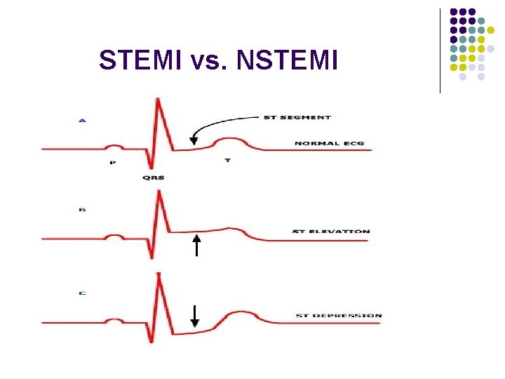 STEMI vs. NSTEMI 