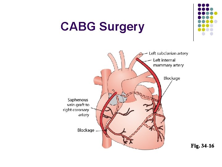 CABG Surgery Fig. 34 -16 