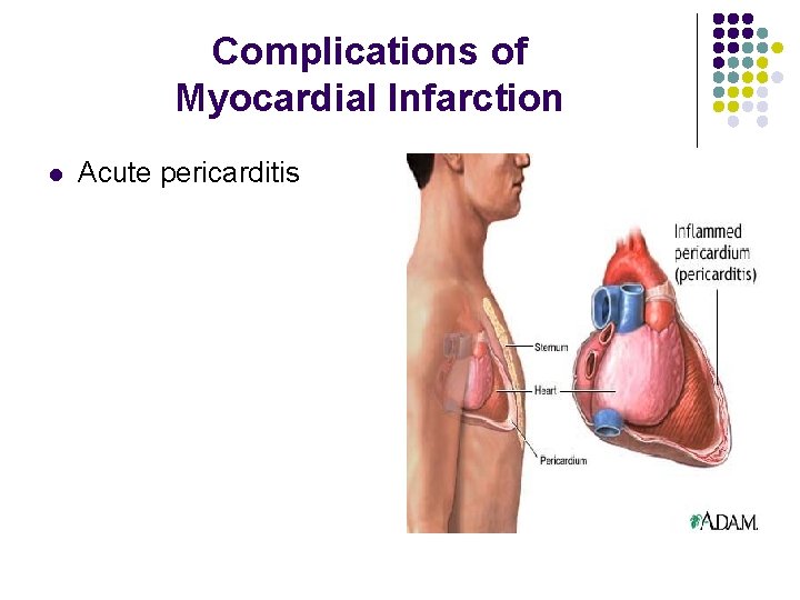 Complications of Myocardial Infarction l Acute pericarditis 