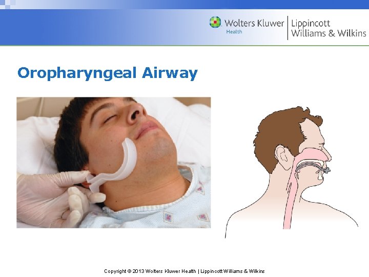 Oropharyngeal Airway Copyright © 2013 Wolters Kluwer Health | Lippincott Williams & Wilkins Oropharyngeal Airway Copyright © 2013 Wolters Kluwer Health | Lippincott Williams & Wilkins