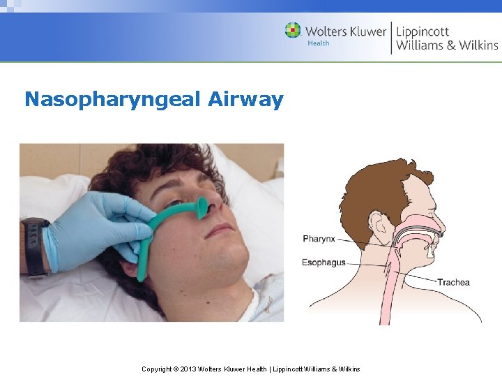 Nasopharyngeal Airway Copyright © 2013 Wolters Kluwer Health | Lippincott Williams & Wilkins Nasopharyngeal Airway Copyright © 2013 Wolters Kluwer Health | Lippincott Williams & Wilkins