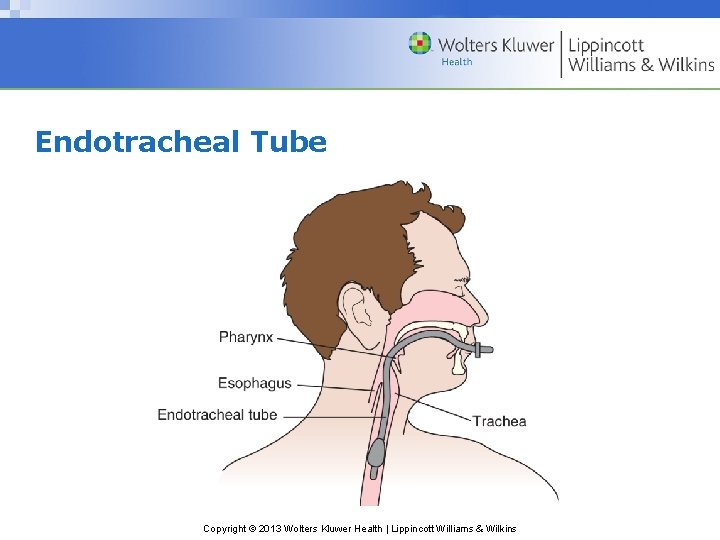 Endotracheal Tube Copyright © 2013 Wolters Kluwer Health | Lippincott Williams & Wilkins Endotracheal Tube Copyright © 2013 Wolters Kluwer Health | Lippincott Williams & Wilkins