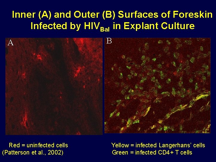 Inner (A) and Outer (B) Surfaces of Foreskin Infected by HIVBal in Explant Culture