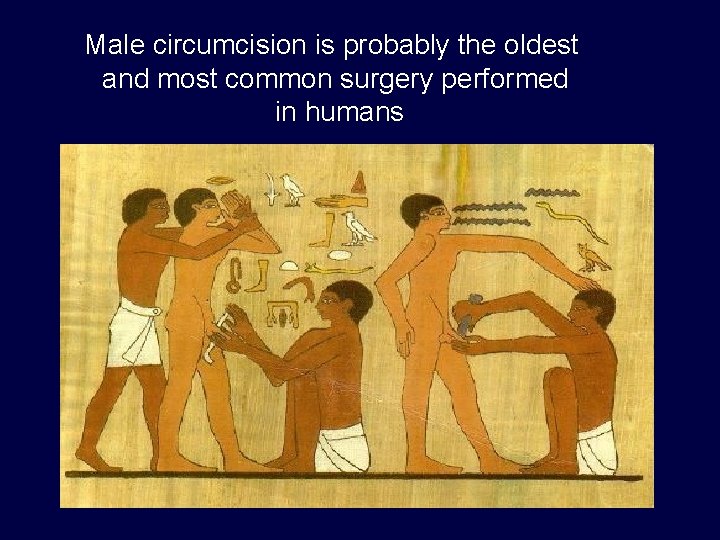 Male circumcision is probably the oldest and most common surgery performed in humans 