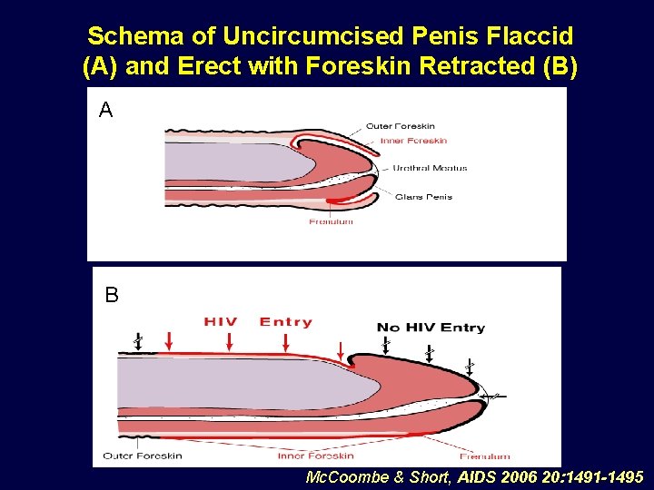 Schema of Uncircumcised Penis Flaccid (A) and Erect with Foreskin Retracted (B) A B