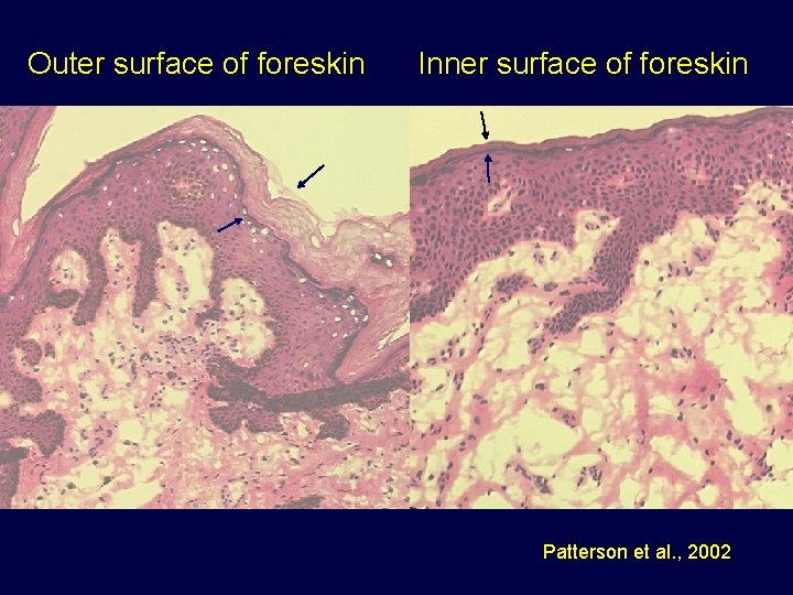 Outer surface of foreskin Inner surface of foreskin Patterson et al. , 2002 