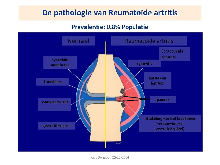 De pathologie van Reumatoïde artritis Prevalentie: 0. 8% Populatie Normaal Reumatoïde artritis Structurele schade