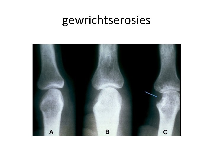 gewrichtserosies 
