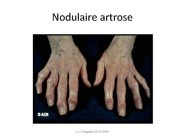 Nodulaire artrose v. r. l. Borgloon 25 -10 -2004 