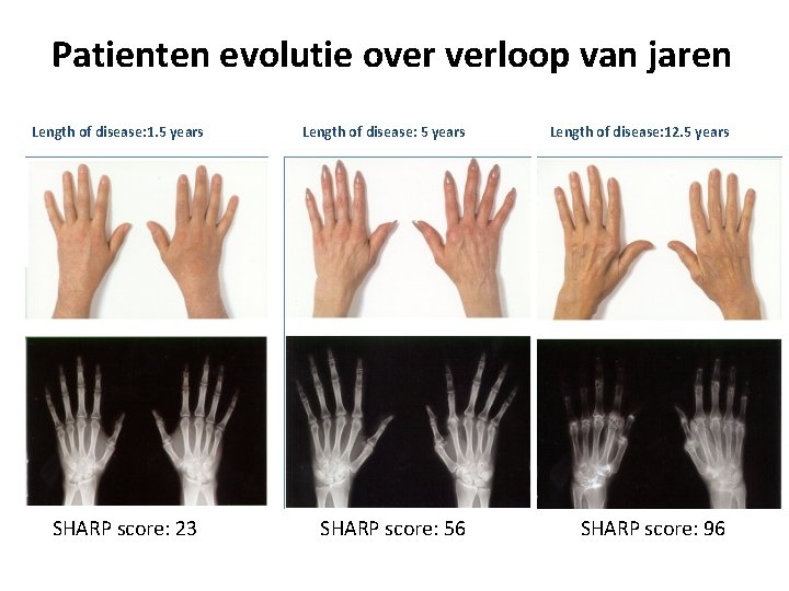 Patienten evolutie over verloop van jaren Length of disease: 1. 5 years SHARP score: