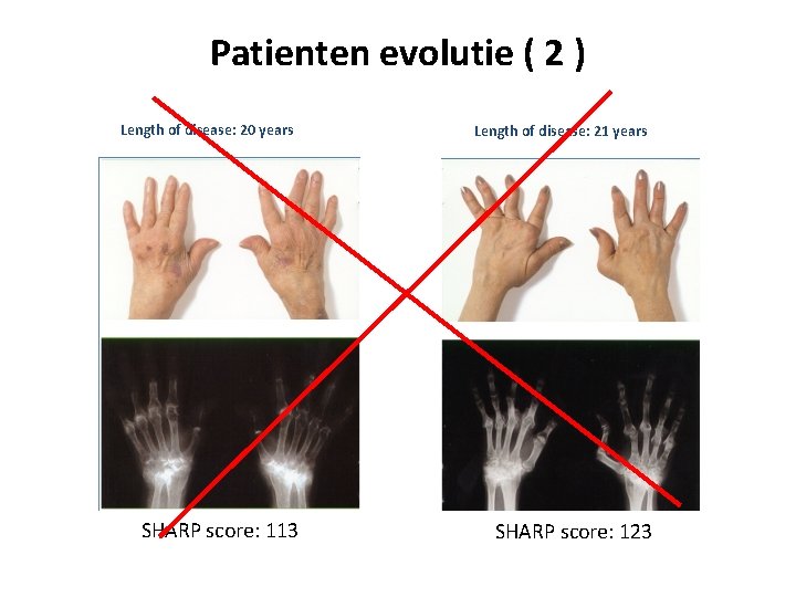 Patienten evolutie ( 2 ) Length of disease: 20 years SHARP score: 113 Length