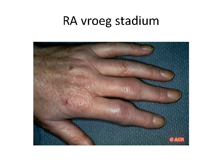 RA vroeg stadium 