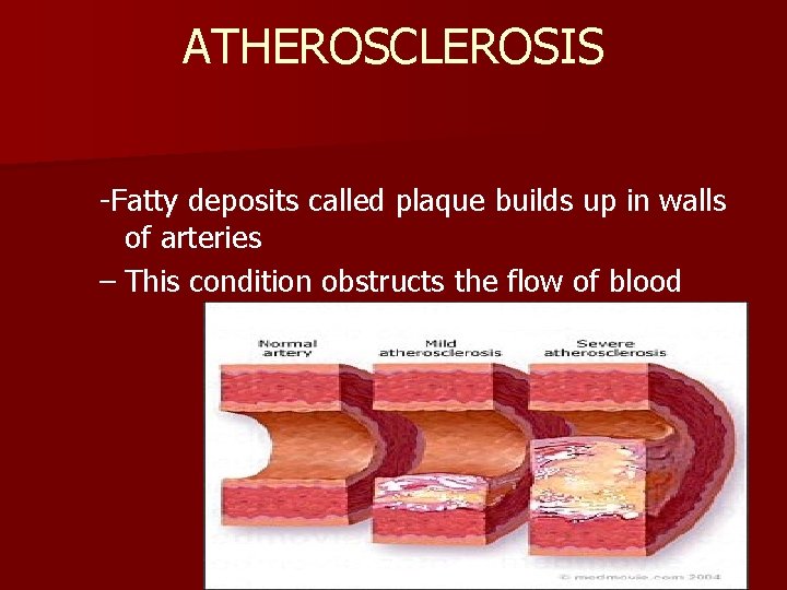 ATHEROSCLEROSIS -Fatty deposits called plaque builds up in walls of arteries – This condition