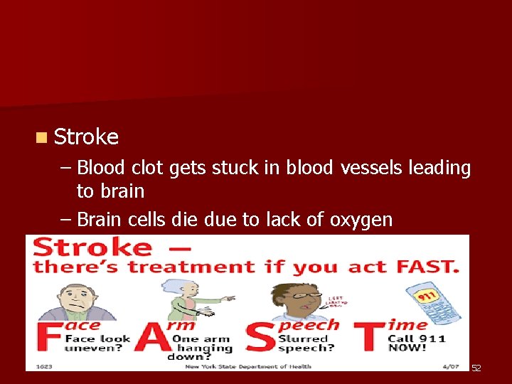 n Stroke – Blood clot gets stuck in blood vessels leading to brain –