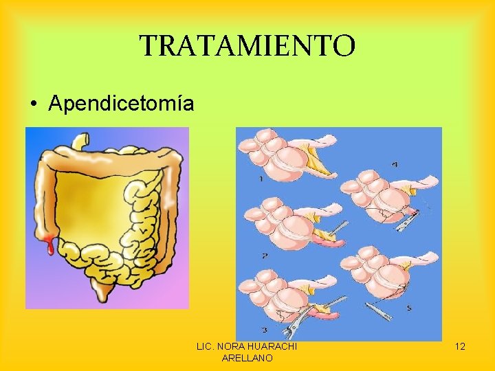 TRATAMIENTO • Apendicetomía LIC. NORA HUARACHI ARELLANO 12 