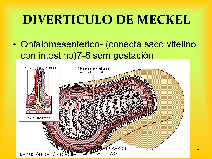 DIVERTICULO DE MECKEL • Onfalomesentérico- (conecta saco vitelino con intestino)7 -8 sem gestación LIC.