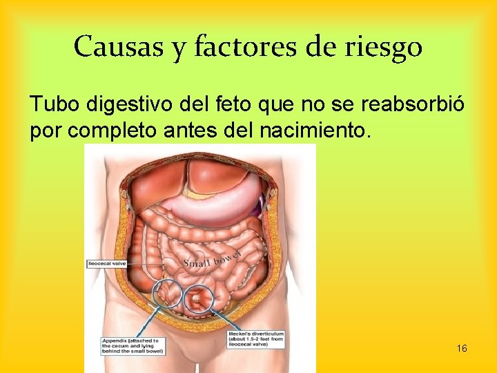 Causas y factores de riesgo Tubo digestivo del feto que no se reabsorbió por