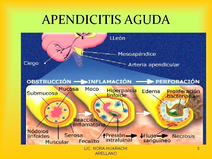APENDICITIS AGUDA LIC. NORA HUARACHI ARELLANO 3 