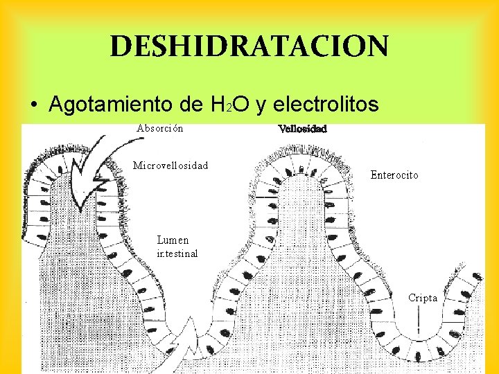 DESHIDRATACION • Agotamiento de H 2 O y electrolitos LIC. NORA HUARACHI ARELLANO 34