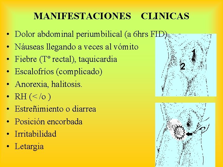 MANIFESTACIONES • • • CLINICAS Dolor abdominal periumbilical (a 6 hrs FID) Náuseas llegando