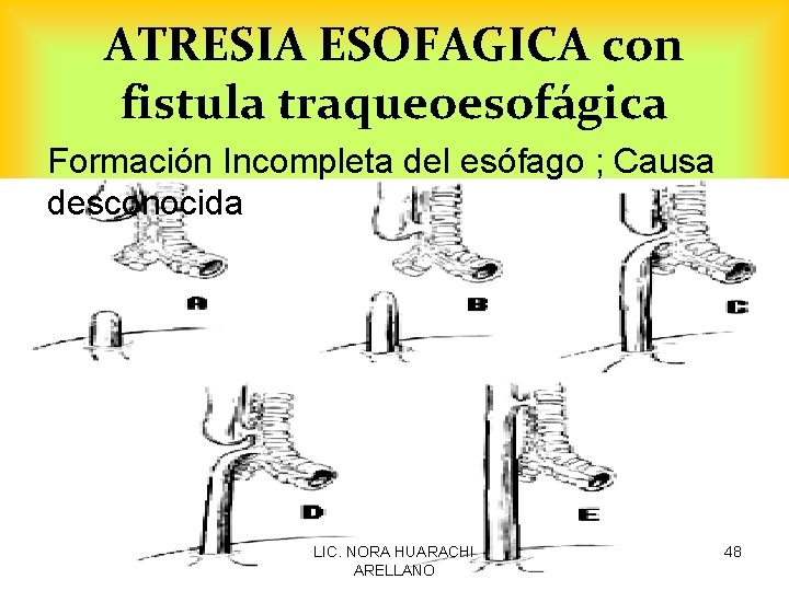 ATRESIA ESOFAGICA con fistula traqueoesofágica Formación Incompleta del esófago ; Causa desconocida LIC. NORA