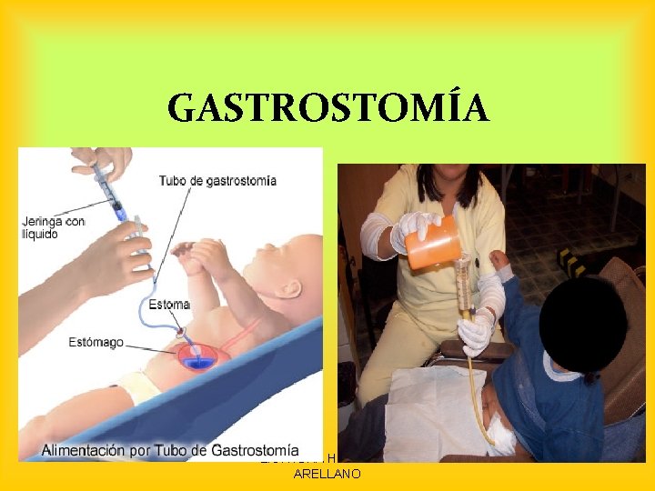 GASTROSTOMÍA LIC. NORA HUARACHI ARELLANO 52 