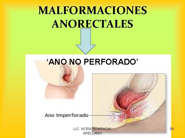 MALFORMACIONES ANORECTALES ‘ANO NO PERFORADO’ LIC. NORA HUARACHI ARELLANO 54 