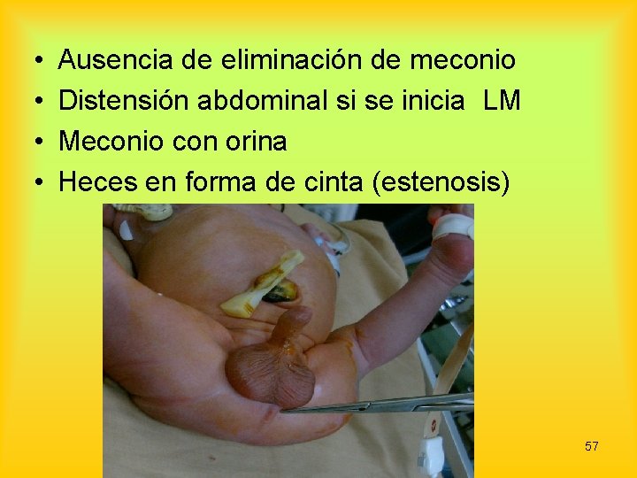  • • Ausencia de eliminación de meconio Distensión abdominal si se inicia LM