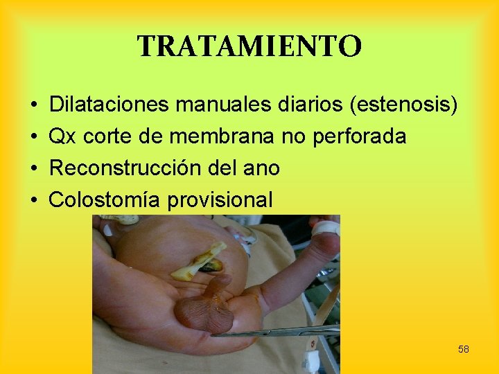 TRATAMIENTO • • Dilataciones manuales diarios (estenosis) Qx corte de membrana no perforada Reconstrucción