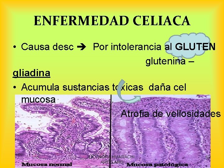 ENFERMEDAD CELIACA • Causa desc Por intolerancia al GLUTEN glutenina – gliadina • Acumula
