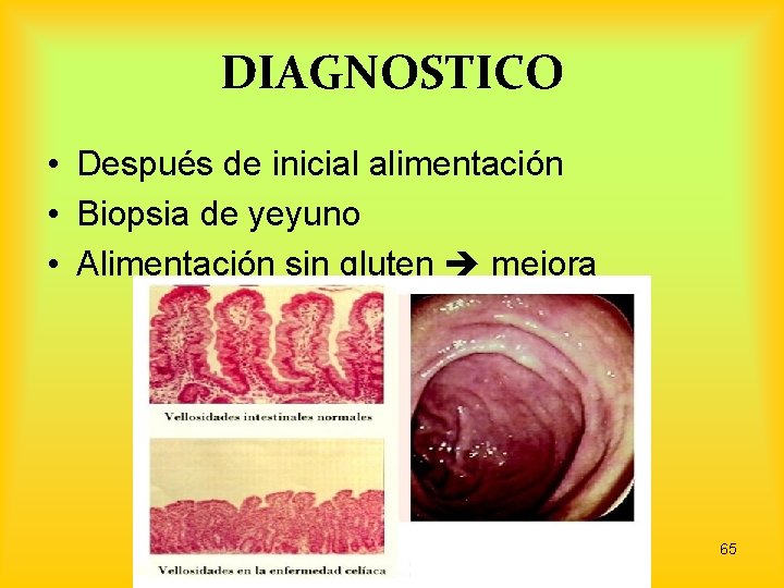 DIAGNOSTICO • Después de inicial alimentación • Biopsia de yeyuno • Alimentación sin gluten